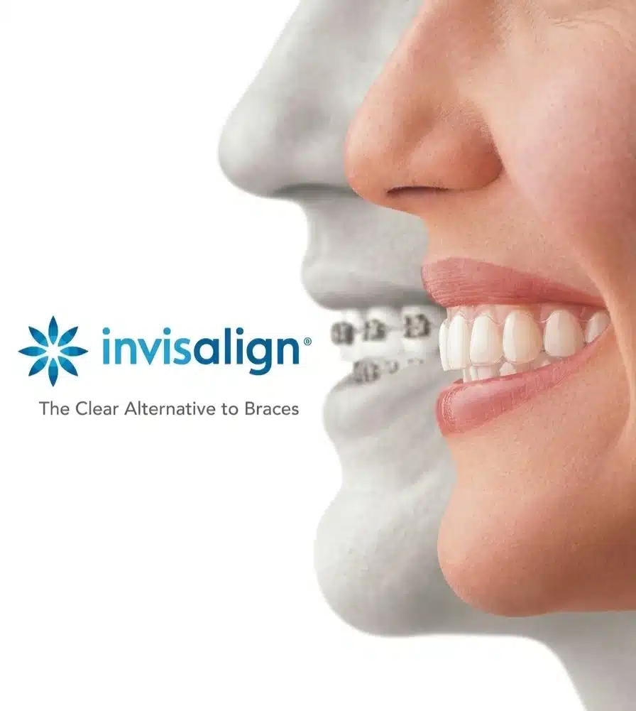 Invisalign
