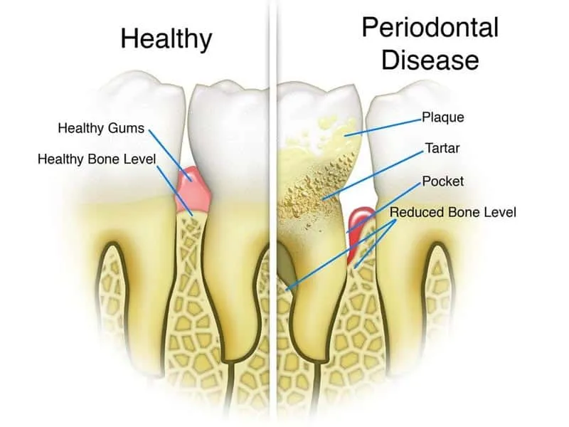 Periodontal