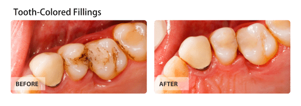 Tooth Colored Fillings