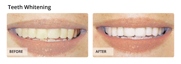 Teeth Whitening