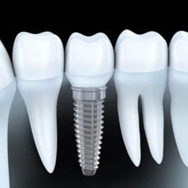 dental implant