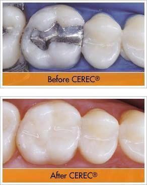 What Are Dental Crowns & Bridges?